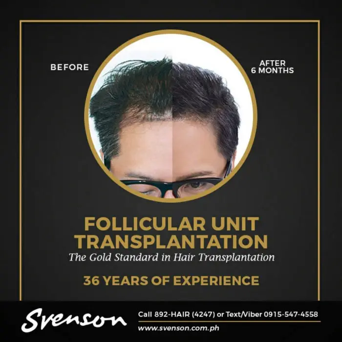 Everything You Need to Know about FUT Hair Transplant