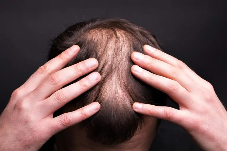 4 Reasons Why Hair Loss Hinders Your Success in the Workplace