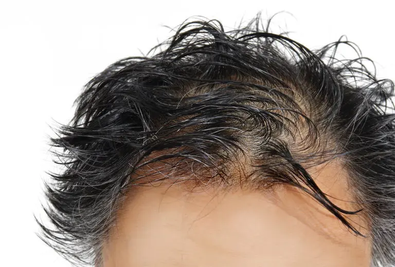 Your Quick Guide To Hair Replacement