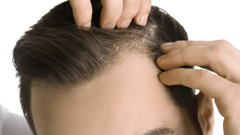 Does Dandruff Cause Hair Loss?