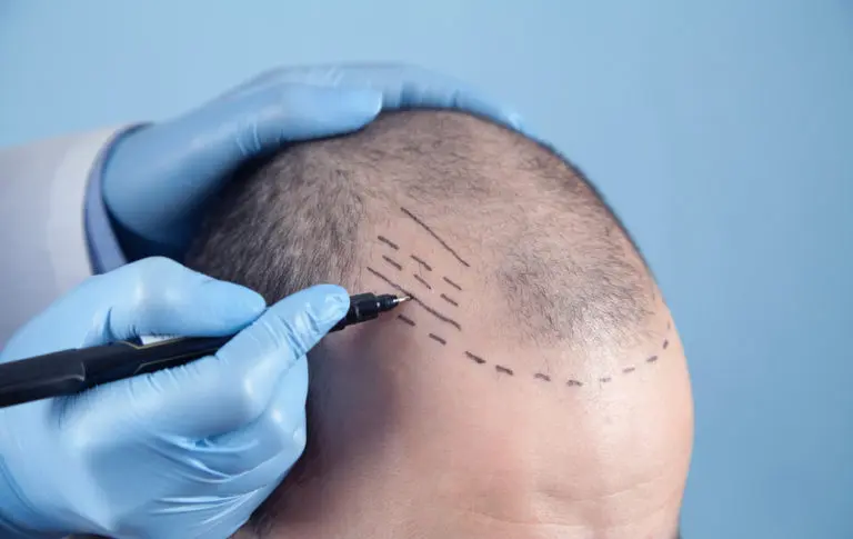 How Do Hair Transplants Work?