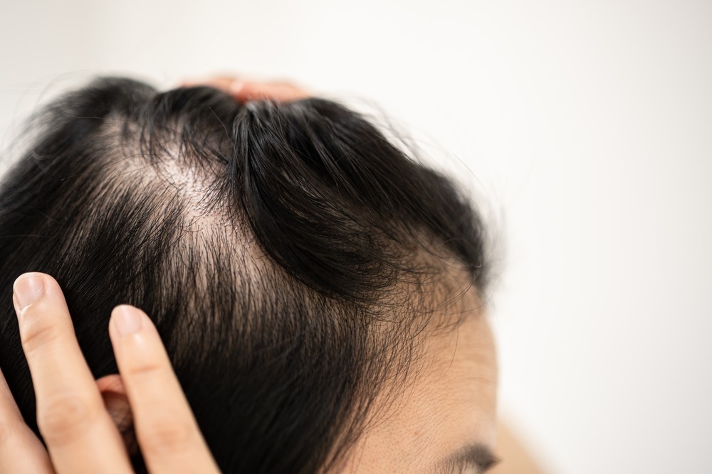 Understanding Androgenetic Alopecia: Causes and Treatments