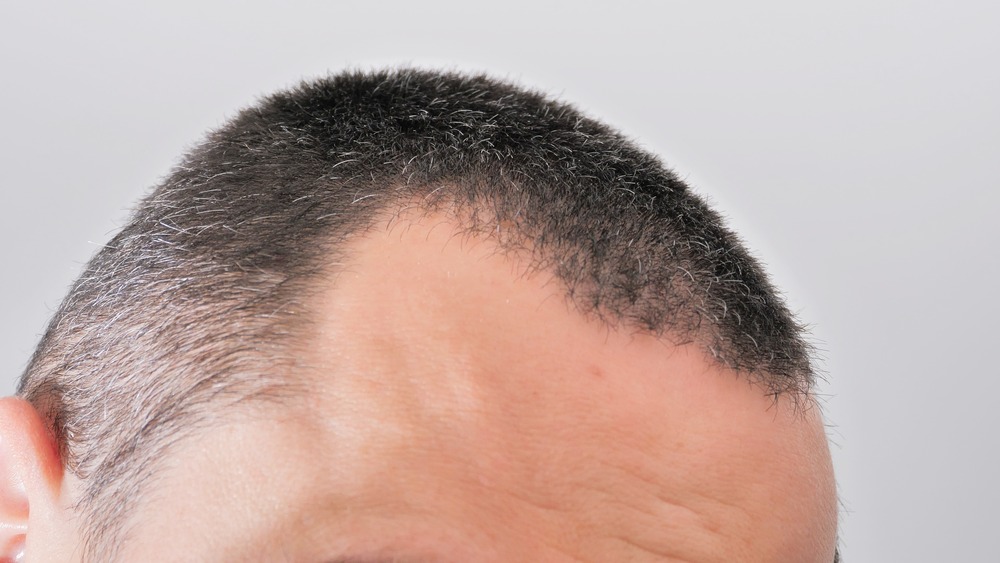 What Causes Baldness? Investigating the Roots of Male Hair Loss