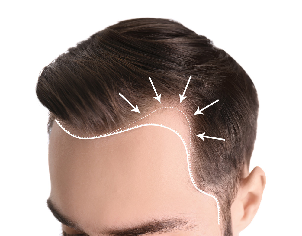 Reclaiming Confidence: The Definitive Guide to Regrowing Hair for Men