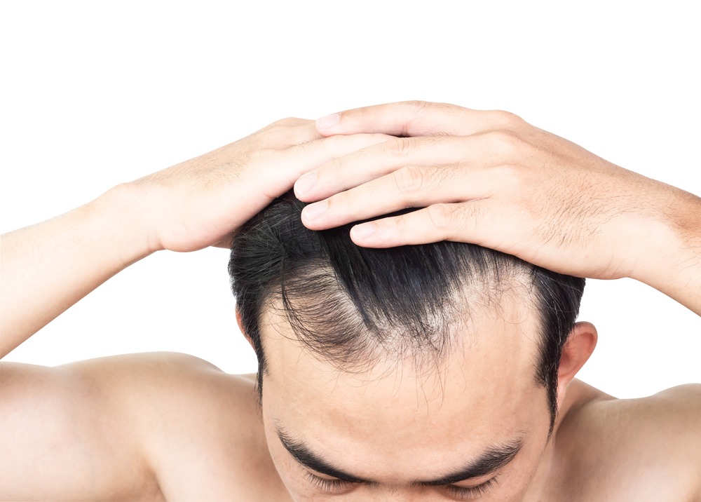 Stop Hair Loss Before it Starts: How to Prevent A Receding Hairline