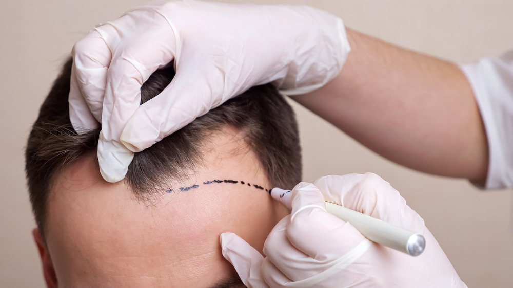 At What Age Should You Get a Hair Transplant?: An Insightful Guide