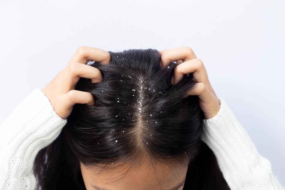 4 Main Causes of Dandruff and What You Can Do to Prevent Them