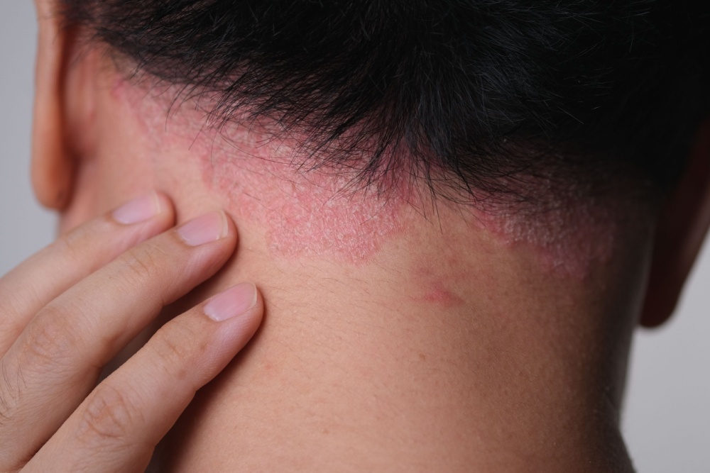 Is It Really Dandruff? Comparing Dandruff vs. Scalp Psoriasis and Other Conditions