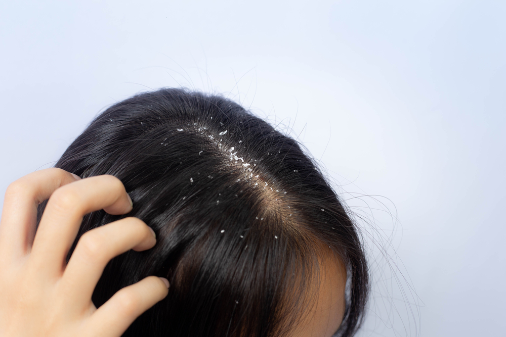 Common Misconceptions About Dandruff