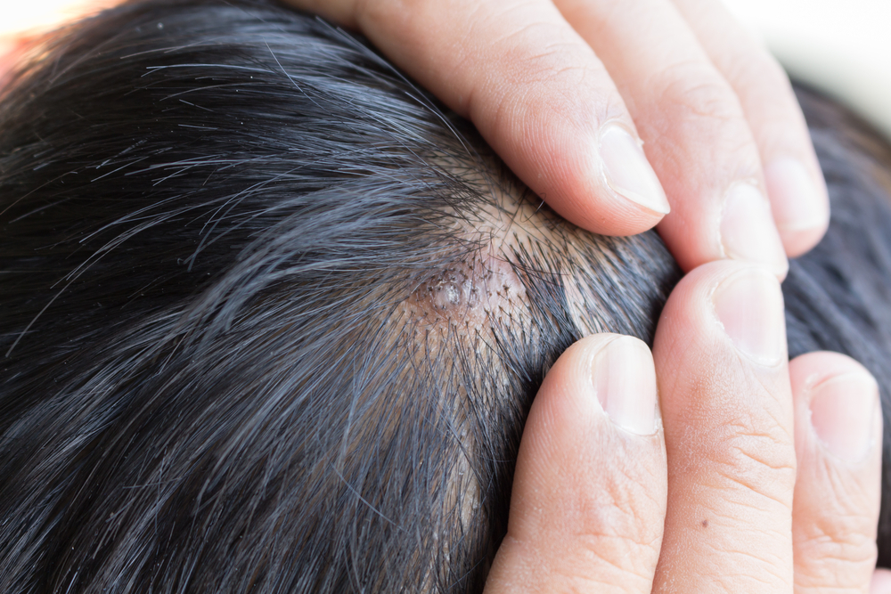 Causes of Scalp Acne: Why Is My Scalp Breaking Out?
