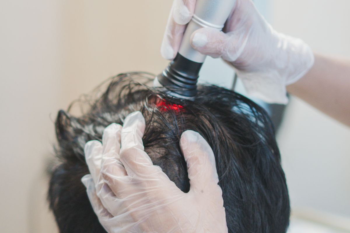 Where Can You Get Hair Restoration in Metro Manila