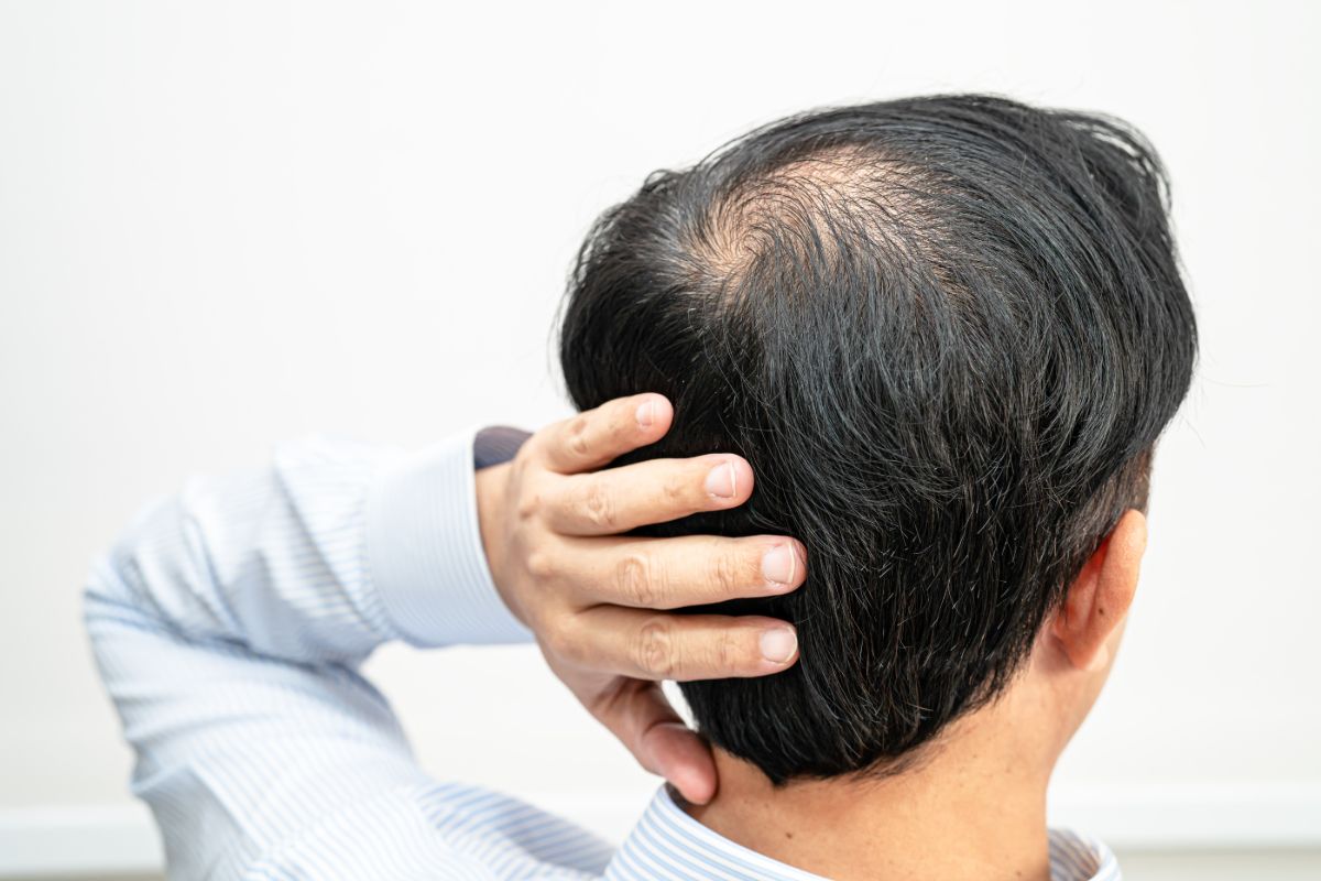 Different Types of Thinning Hair Solutions for Men