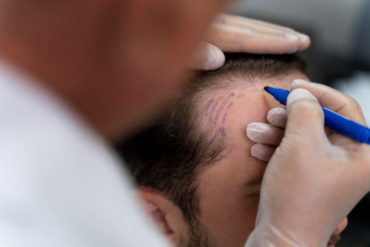 Hair Transplant Price Breakdown: A Beginner’s Guide