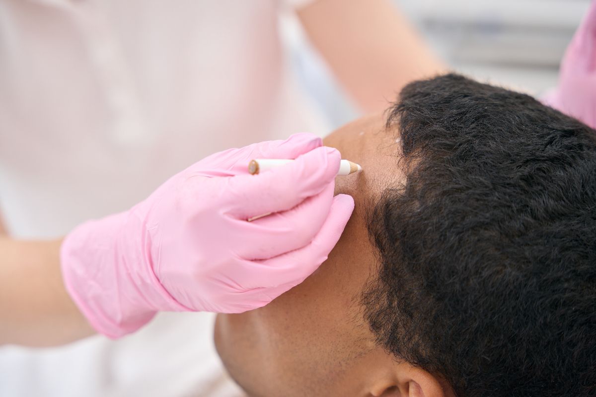 FUE vs. FUT Hair Transplant: What to Choose?