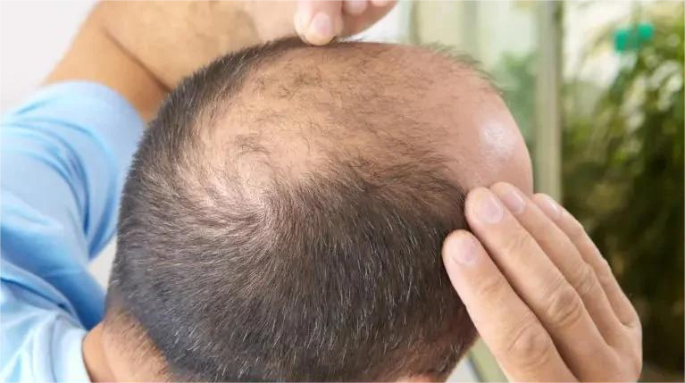 Hair Replacement & Hair Transplant Options