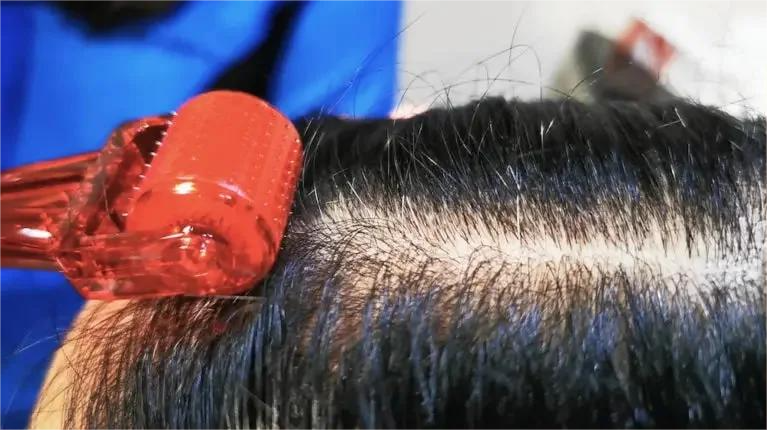 Hair Recovery Program