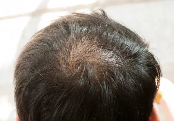 Hair Replacement