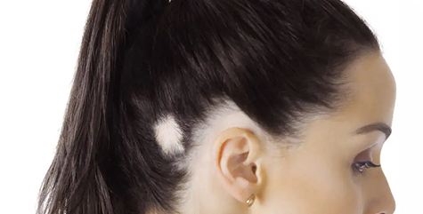 Alopecia Areata Treatment 