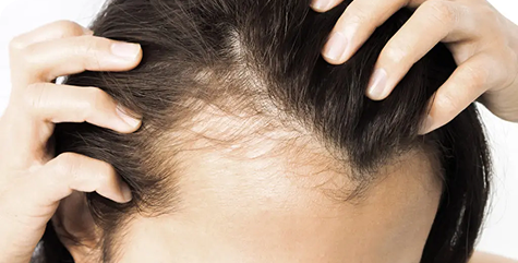 Thinning Hair Solutions 