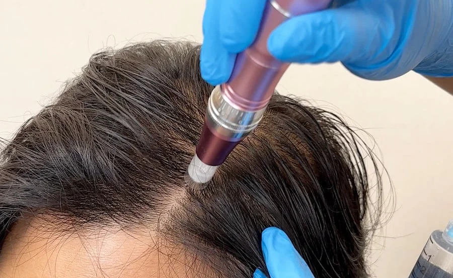 NexoHair is next-level hair and scalp intervention using exosomes